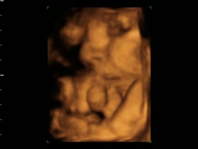 Renkli ultrason 4 boyutlu ultrason
